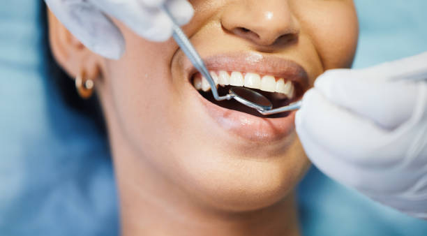 Teeth Whitening in SC
